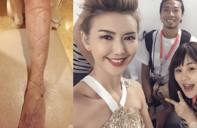 Oh no Stefanie Sun shows off injuries from ‘being vain’! B2.png